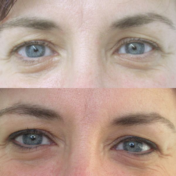 delineado definitivo en ojos micropigmentacion